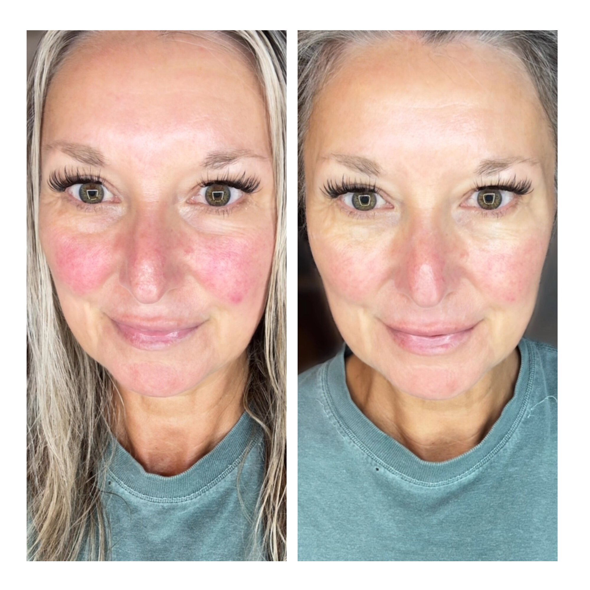 Quick Fix Spot Gel | LimeLife