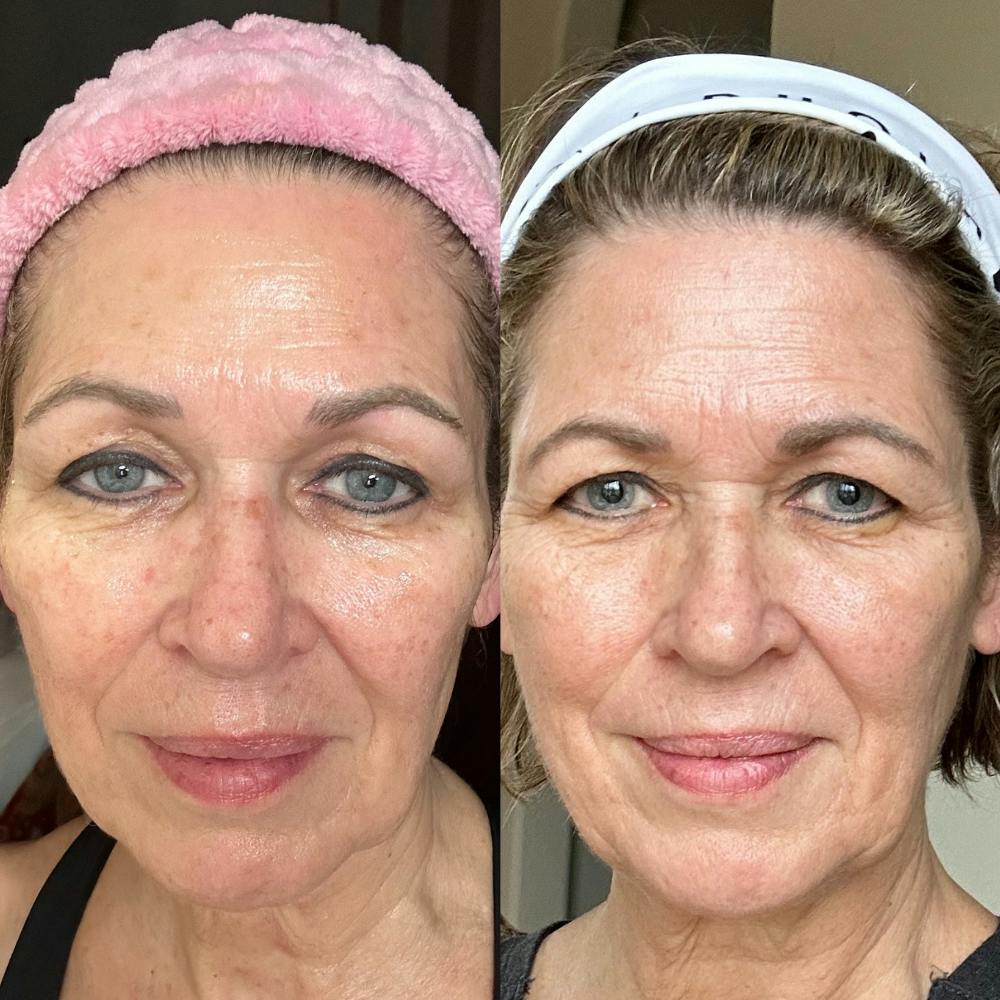 Before & After using DUOLAB